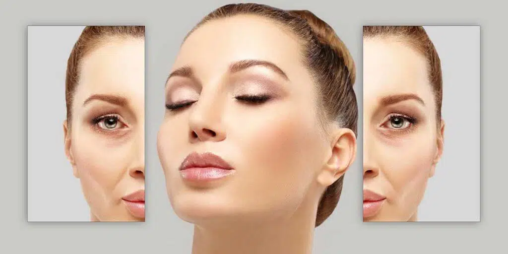 Botox® and Dermal Fillers