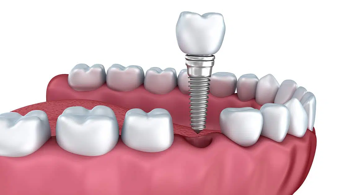 Implant restorations