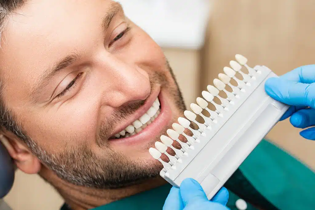 How Long Do Veneers Last?