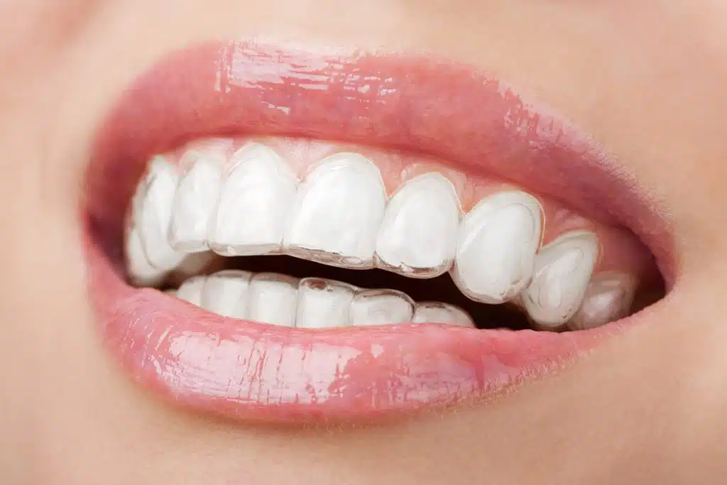 How Long Does Invisalign Take to Straighten Teeth?