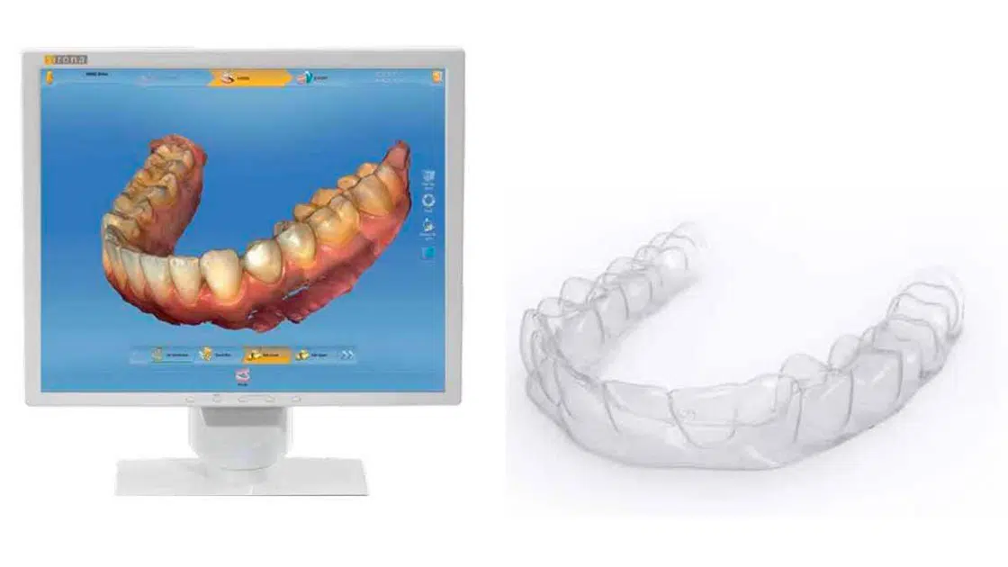 Invisalign