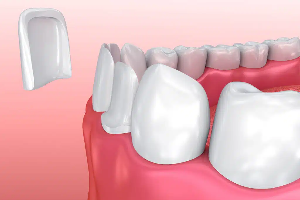 Porcelain Veneers vs. Composite Bonding: What's Best for Long-Lasting Smile Improvements?