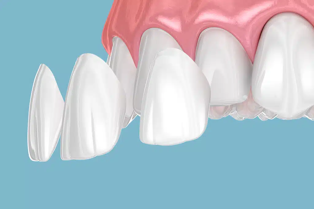 What to Know Before Getting Cosmetic Bonding on Front Teeth